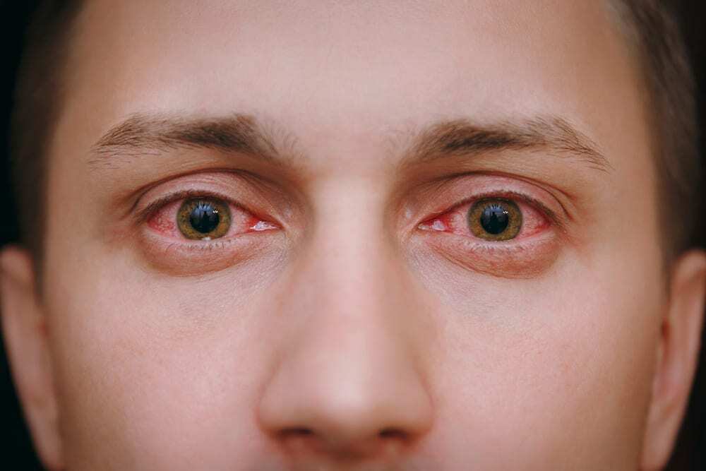 Is it Possible to Prevent Redeye When Smoking Weed?